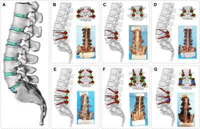 Frontiers Biomechanical Comparative Analysis Of Conventional Pedicle